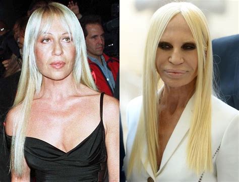 donatella versace before surgery|Donatella Versace Before and After Plastic Surgery.